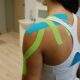 Kinesiotaping zastosowany na zespół bolesnego barku.