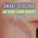 stłuczenia