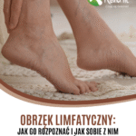 obrzęk limfatyczny